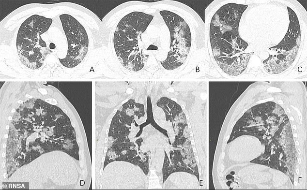 shocking chest X-rays of coronavirus