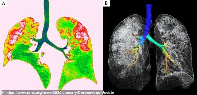 Air Spaces in lungs