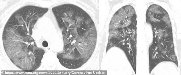 X-ray of the 54-year-old woman