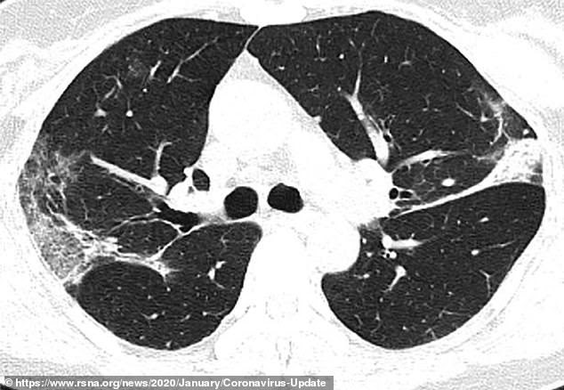 CT scan of a 45-year-old woman from Sichuan